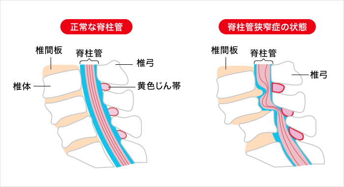 脊柱管狭窄症　画像